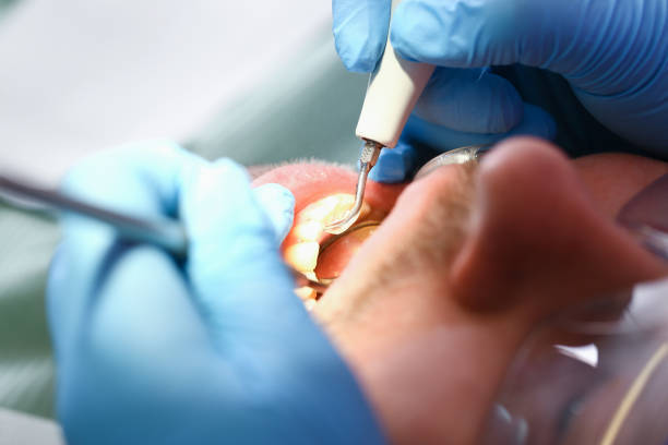 Best Emergency Root Canal Treatment in Aledo, TX